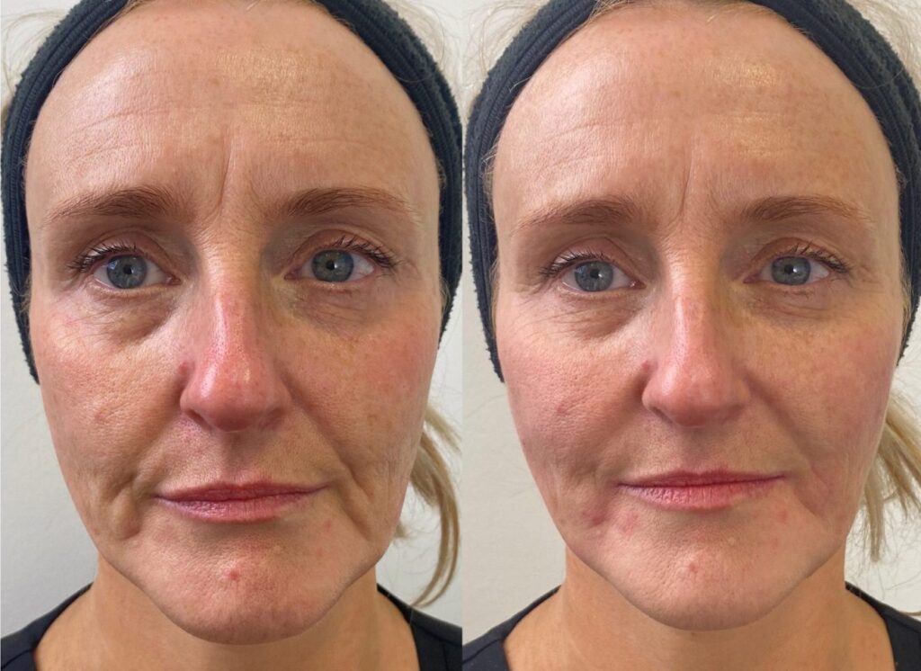 Dermal Filler in Bodrum Before After