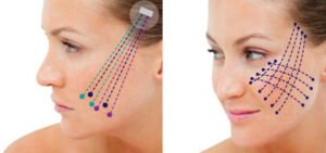 Cosmetic Botox in Bodrum