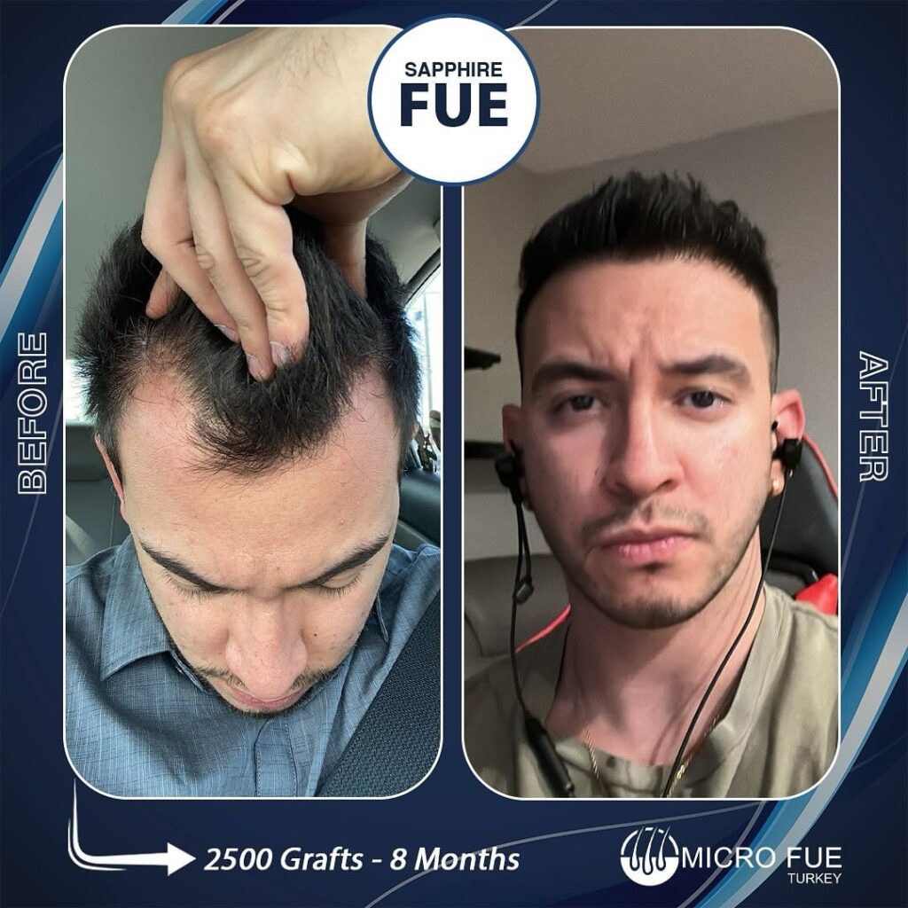 PRP Treatment in Bodrum Before After