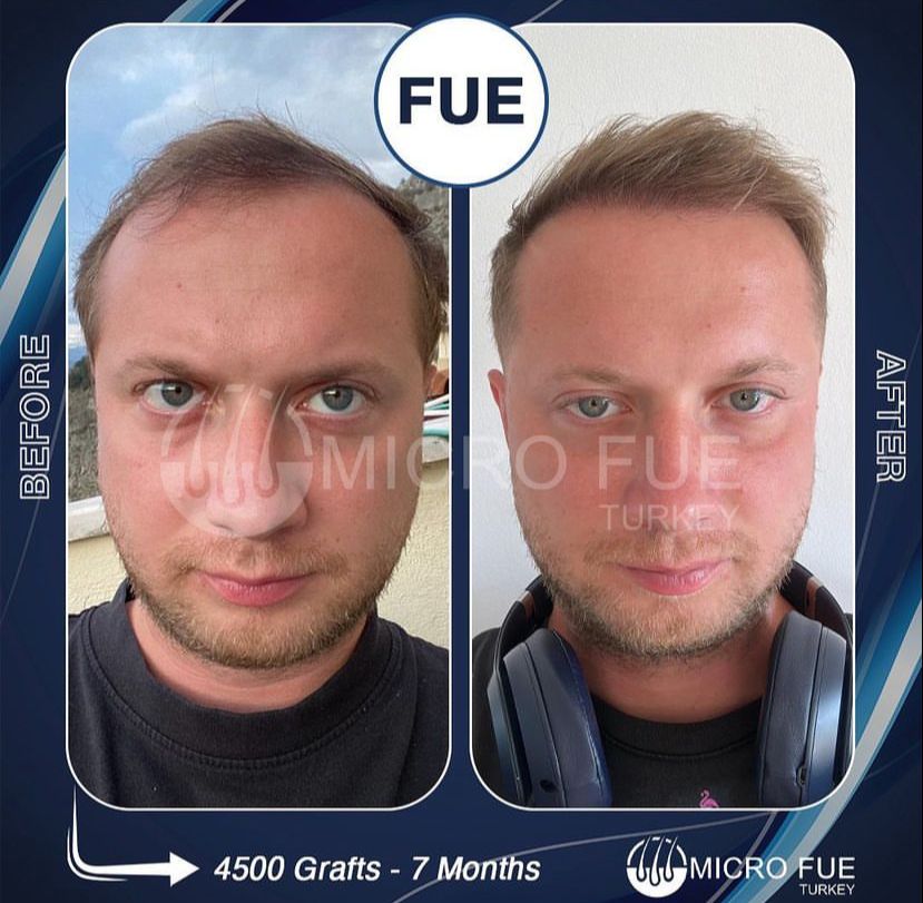 PRP Treatment in Bodrum Before After