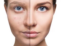 Dermapen in Bodrum Before After