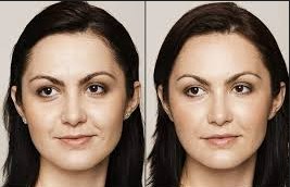 Hyaluronic Acid Fillers in Bodrum