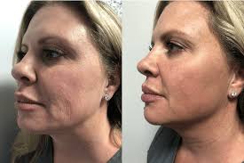 Cosmetic Botox in Bodrum