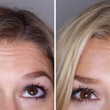Cosmetic Botox in Bodrum
