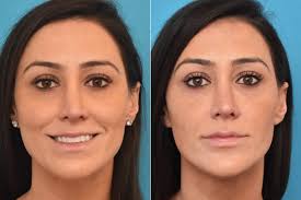 Dermal Filler in Bodrum Before After