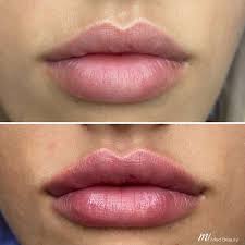 Russian Lips Bodrum