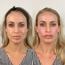 How Much Do Lip Fillers Cost in Turkey?