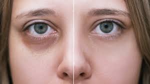 Under Eye Fillers in Bodrum Before After
