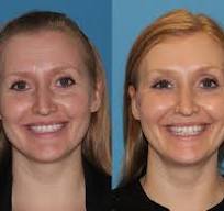 Botox in Bodrum Before After