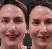 Botox in Bodrum Before After