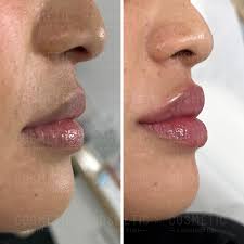 Russian Lips Bodrum