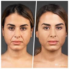Nasolabial Fillers in Bodrum Before After