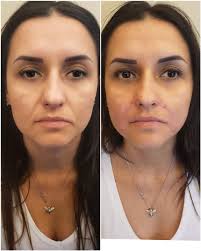 Nasolabial Fillers in Bodrum Before After