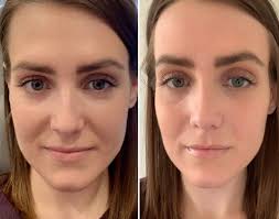 Nasolabial Fillers in Bodrum