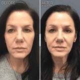 Collagen Stimulation