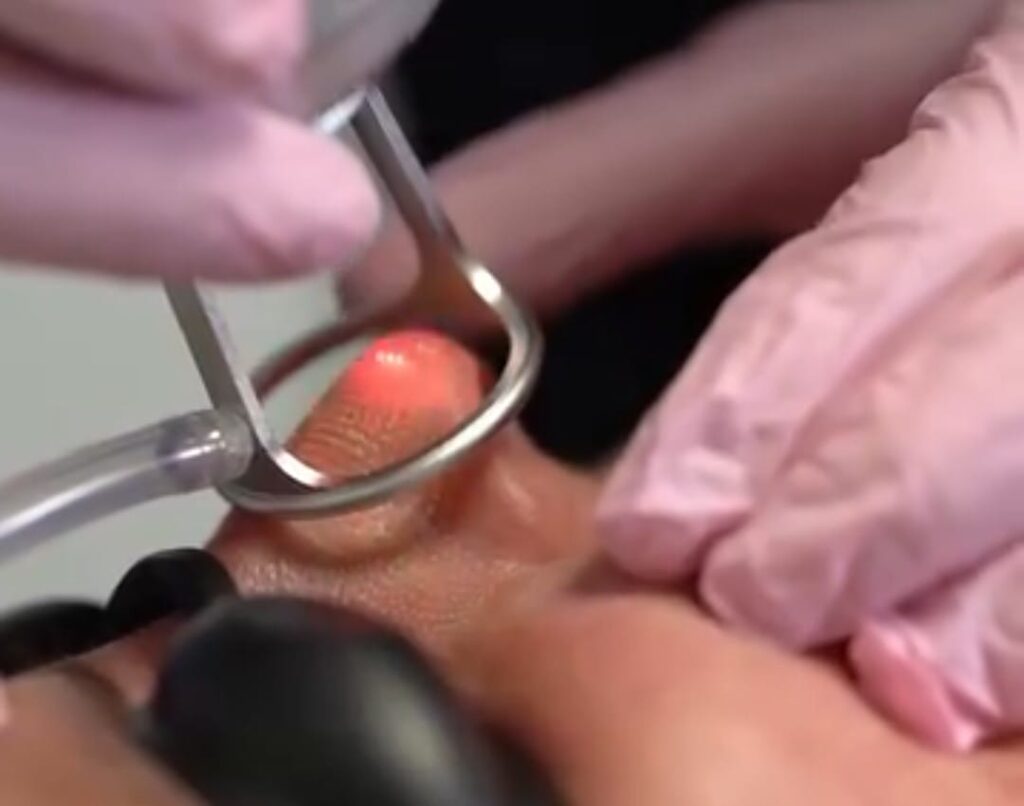 CO2 Fractional Laser in Bodrum
