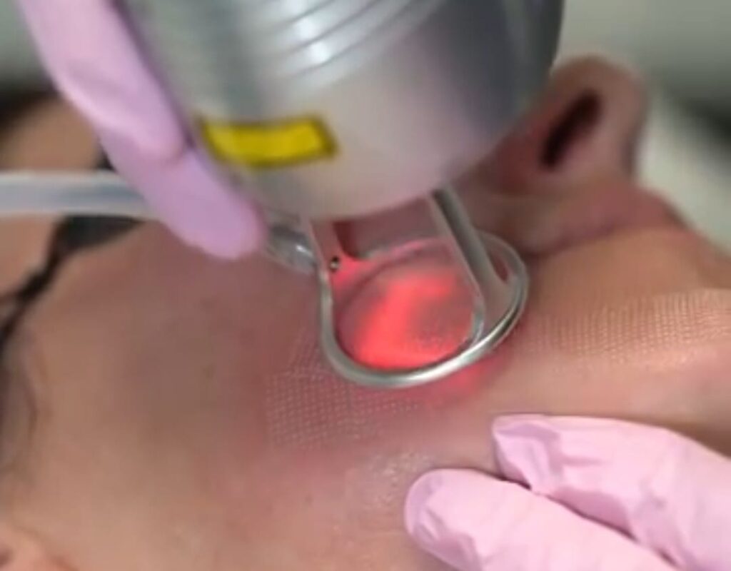 CO2 Fractional Laser in Bodrum
