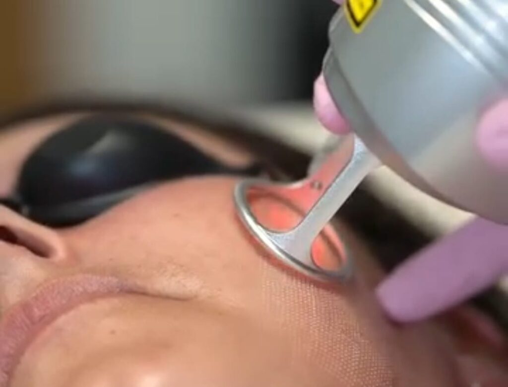 CO2 Fractional Laser in Bodrum