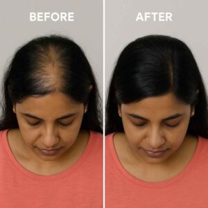 Hair Restoration in Bodrum